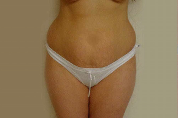 Antes - abdominoplastia