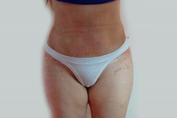 Después - abdominoplastia