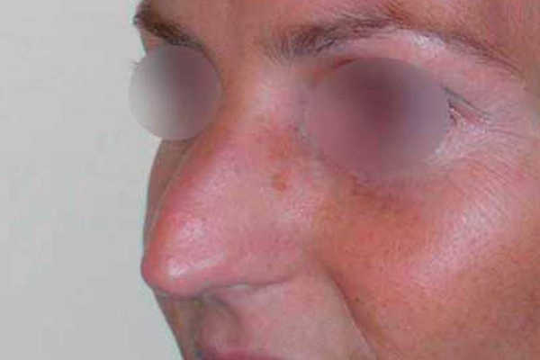 Antes - rinoplastia