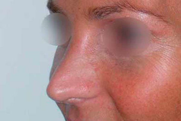 Después - rinoplastia